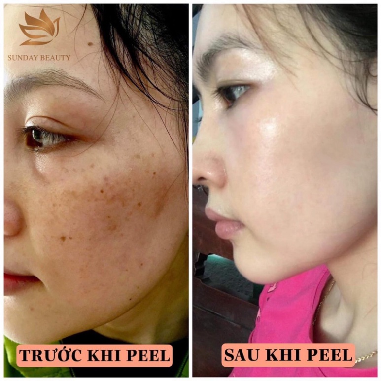 Peel da bong mảng to ROYCE SKIN M+ thay da mụn thâm nám tàn nhang sẹo rỗ lõm .