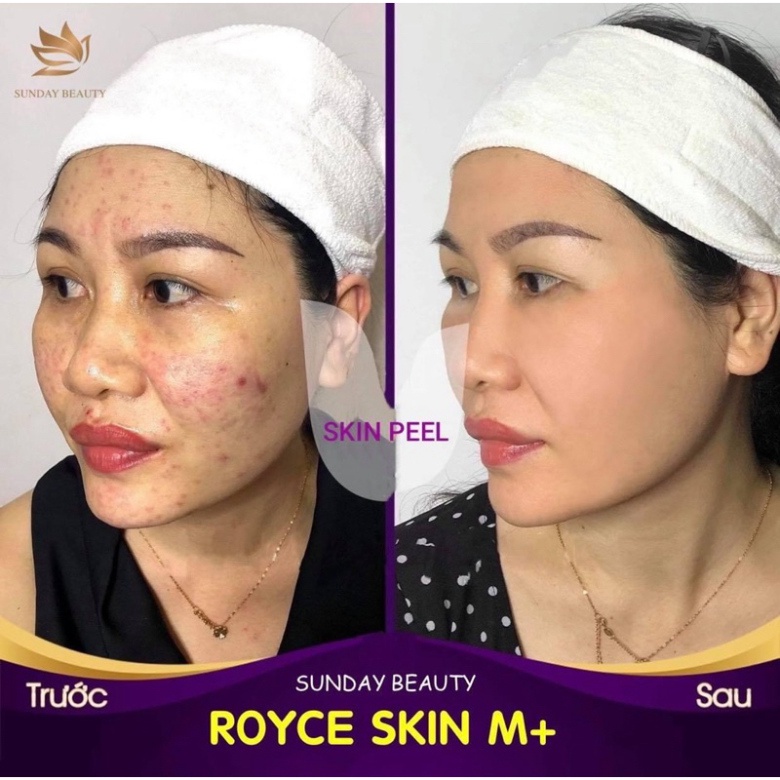 Peel da bong mảng to ROYCE SKIN M+ thay da mụn thâm nám tàn nhang sẹo rỗ lõm .