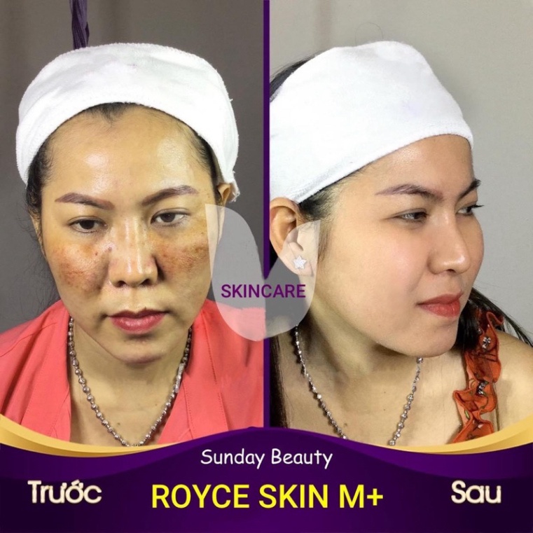 Peel da ROYCE SKIN M+ Peel da tiện lợi dễ sử dụng .