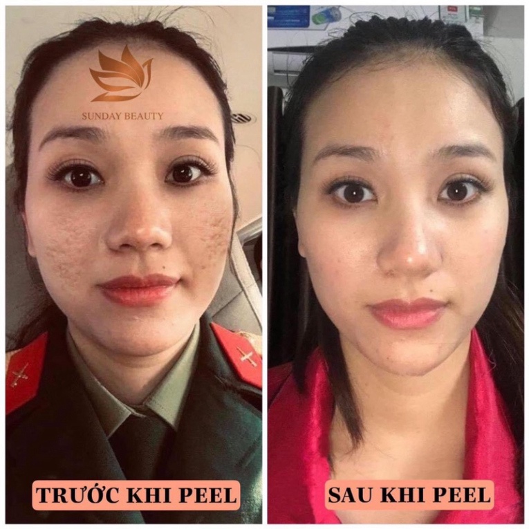 Peel da ROYCE SKIN M+ Peel da sinh học chuẩn minh tinh .