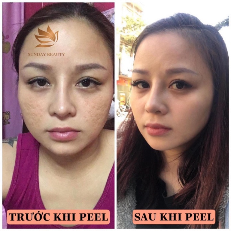 Peel da ROYCE SKIN M+ Peel da sinh học chuẩn minh tinh .