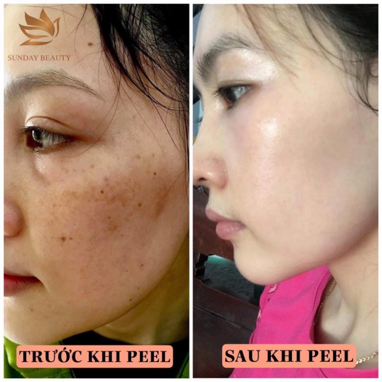 Peel da bong mảng to ROYCE SKIN M+ bóc tách nám tàn nhang sẹo rỗ mụn thâm .