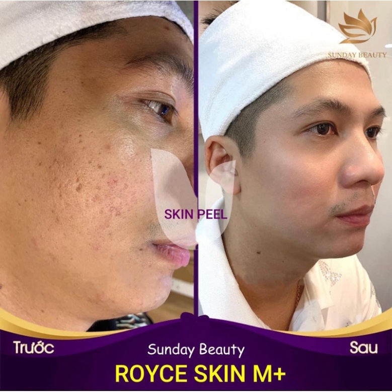 Peel da bong mảng to ROYCE SKIN M+ bóc tách nám tàn nhang sẹo rỗ mụn thâm .