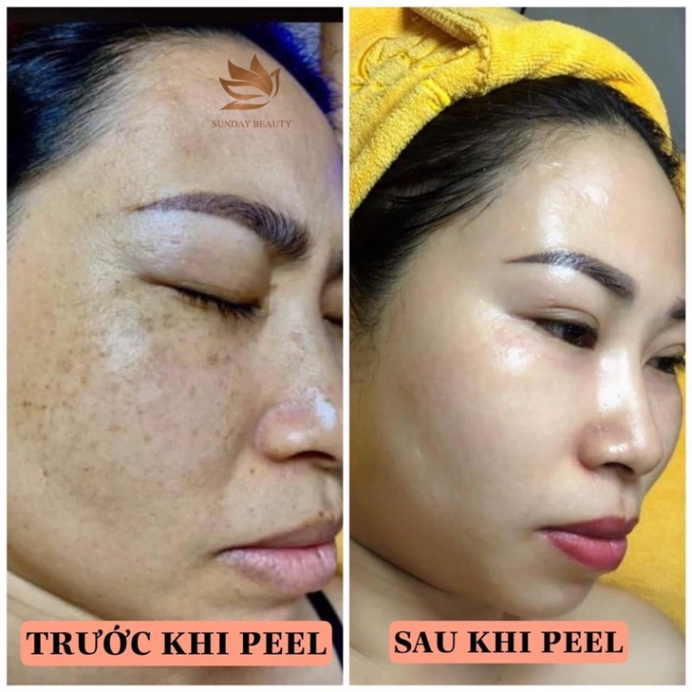 Peel da ROYCE SKIN M+ Peel da mang lại vẻ đẹp tiềm ẩn .