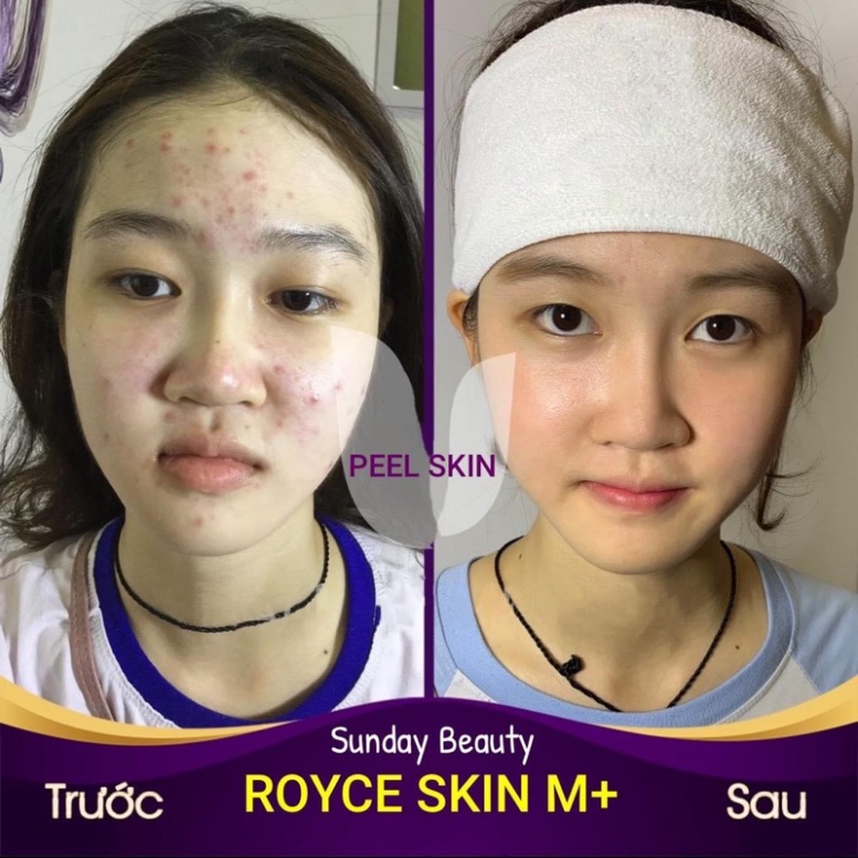 Peel da ROYCE SKIN M+ Da bong mảng to phù hợp cho mọi đối tượng .