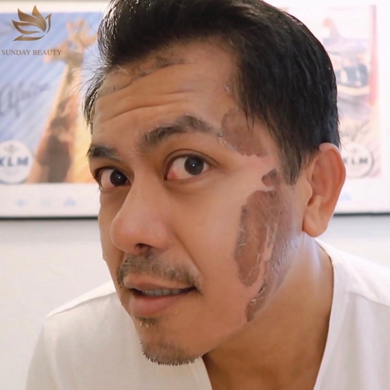 Peel da bong mảng to ROYCE SKIN M+ thay da tách sẹo rỗ lõm nám tàn nhang mụn thâm .