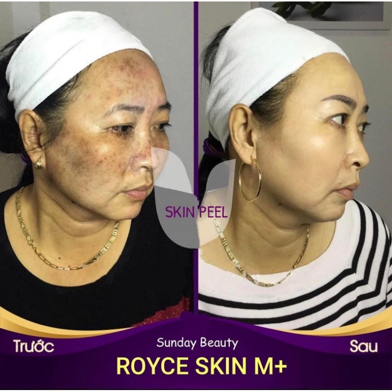 Peel da bong mảng to ROYCE SKIN M+ thay da tách sẹo rỗ lõm nám tàn nhang mụn thâm .