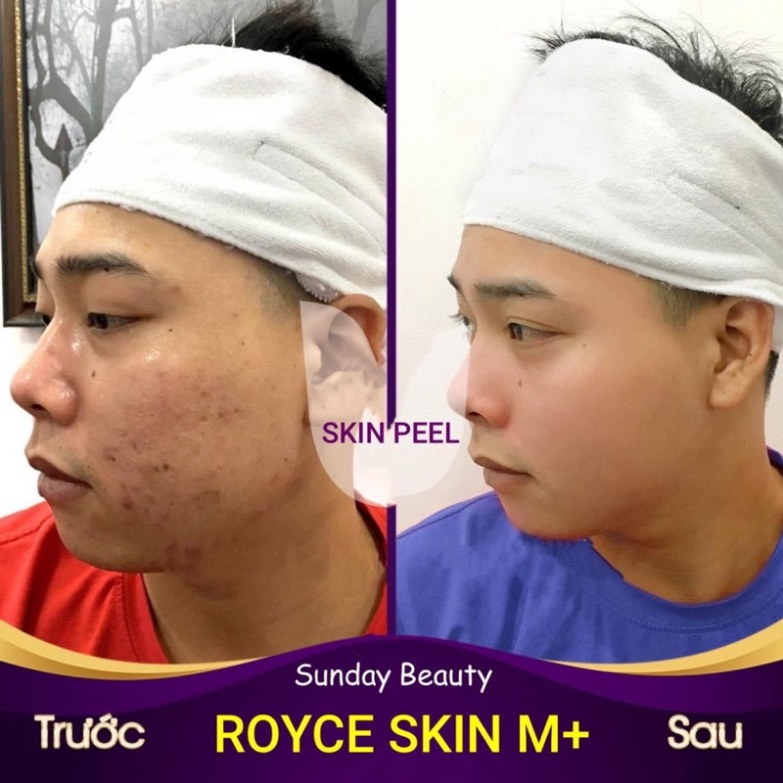 Peel da bong mảng to ROYCE SKIN M+ thay da tách sẹo rỗ lõm nám tàn nhang mụn thâm .