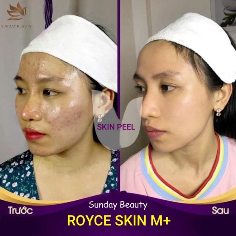 Peel da bong mảng to ROYCE SKIN M+ thay da tách sẹo rỗ lõm nám tàn nhang mụn thâm .