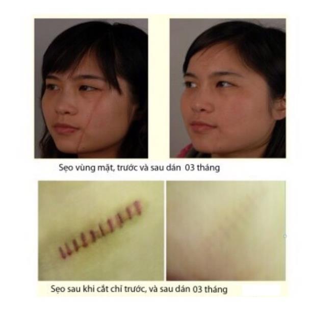 Tấm dán loại bỏ sẹo dùng cho sẹo thâm, sẹo lõm, sẹo tai nạn Scar Fx 2.5x2.5cm/ 3x10cm/10x20cm