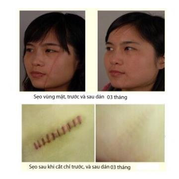 Miếng Dán Xẹp Sẹo Lồi / Phì Đại REJUVASKIN Scar Fx 1x20cm - 2x20cm - 3x20cm - 5x10cm - 10x10cm Chính Hãng