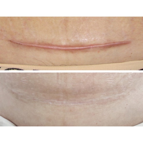 Miếng Dán Xẹp Sẹo Lồi / Phì Đại REJUVASKIN Scar Fx 1x20cm - 2x20cm - 3x20cm - 5x10cm - 10x10cm Chính Hãng