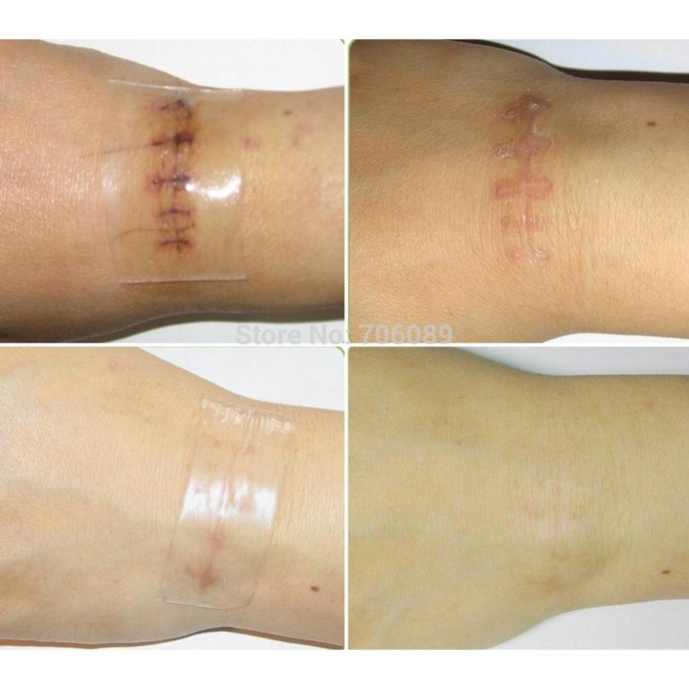 Miếng Dán Xẹp Sẹo Lồi / Phì Đại REJUVASKIN Scar Fx 1x20cm - 2x20cm - 3x20cm - 5x10cm - 10x10cm Chính Hãng