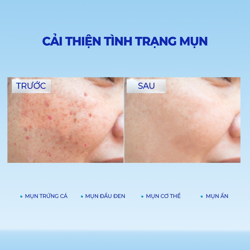 Gel Giảm Mụn Mờ Thâm Blissberry 15ml