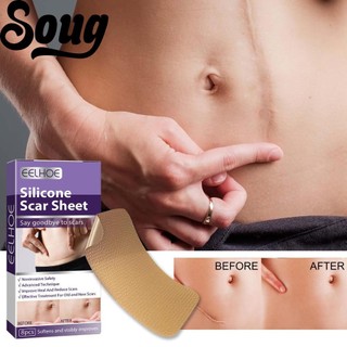 SOUG Set 8 Miếng Dán Silicone V2Q2 Giúp Hỗ trợ giảm sẹo Và Vết Rạn Da