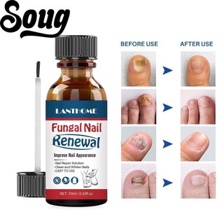 SOUG Tinh chất hỗ trợ cải thiện nấm móng tay và chân Lanthome Z4K1 hiệu quả an toàn 10ml