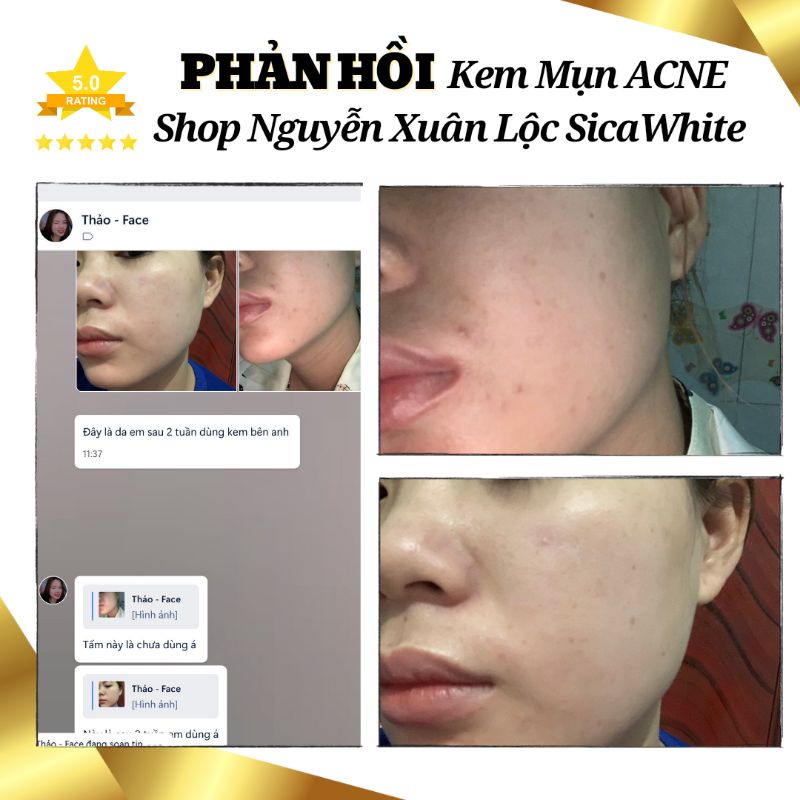 - Kem Mụn - Hỗ trợ Da Mụn, Dưỡng Trắng, Cải thiện Thâm