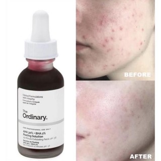 Tinh Chất Peel da The Ordinary AHA 30%+BHA 2% Peeling Solution 30ml- CH