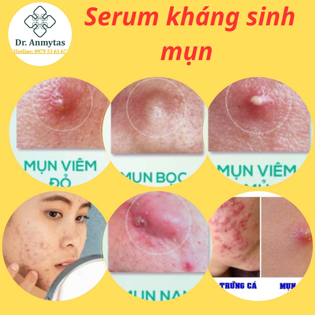 Serum Acnes Kháng Sinh Mụn Dranmytas Cao Cấp.