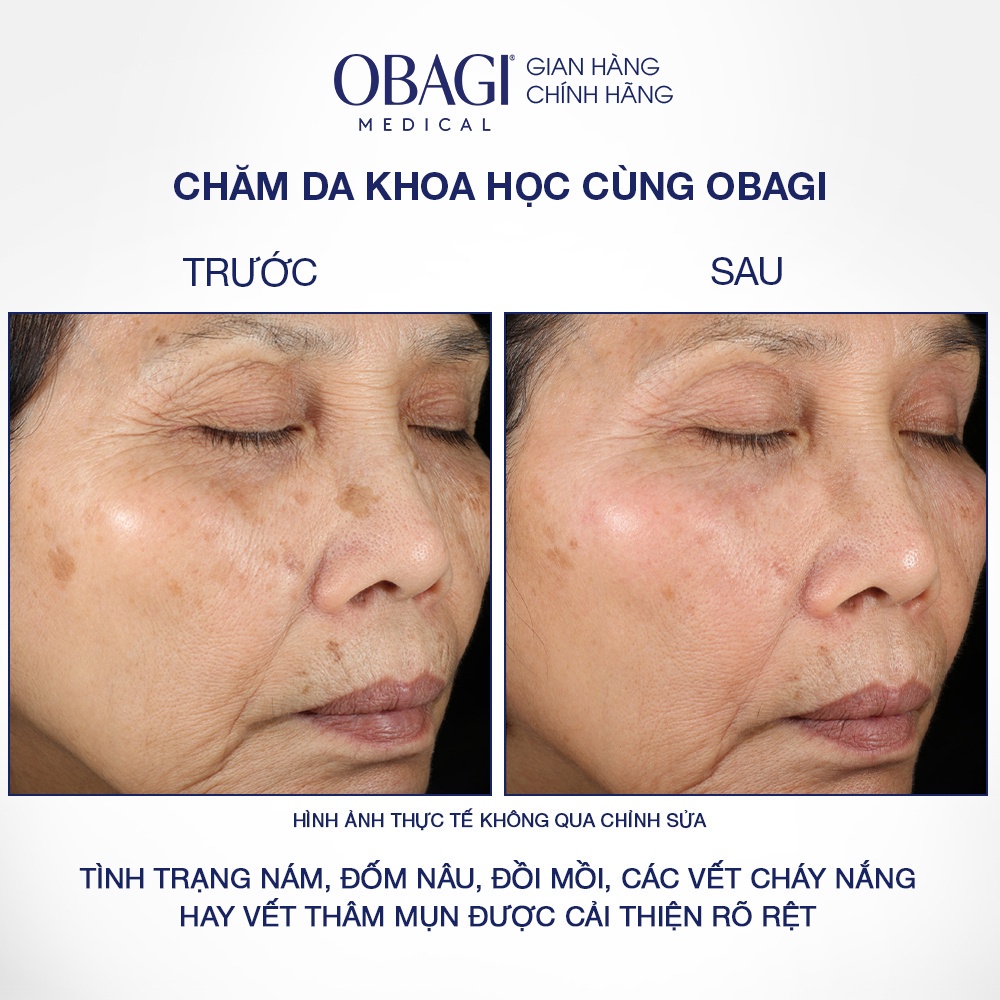 Kem Dưỡng Sáng Da & Mờ Nám Obagi Nu-Derm Clear Fx 57g