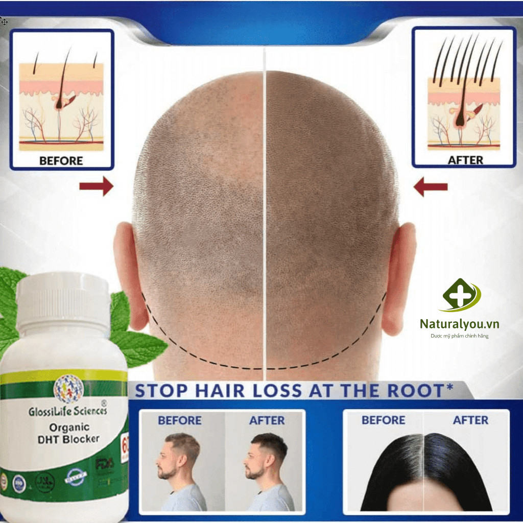 Viên Uống Hữu Cơ DHT Blocker Organic (Hộp 60) Viên Giảm Nhờn Da Đầu Mọc Tóc, Ngăn Rụng Tóc Chính Hãng Ấn Độ| Dr.Dung Ski