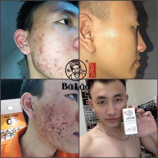 Combo Cao Cấp Bà Lão Serum Mụn Thâm Sẹo Và Đinh Hương Bột Kèm Mặt Nạ Dưỡng