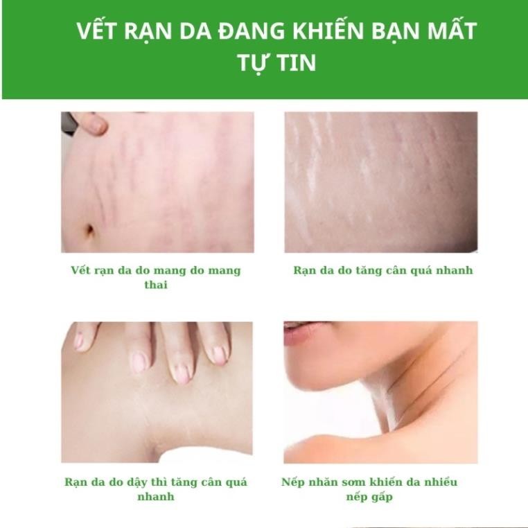 Kem rạn da SNMLPM hỗ trợ giảm sẹo sau sinh Kem dạn da sau sinh làm trắng và săn chắc mịn màng TP07