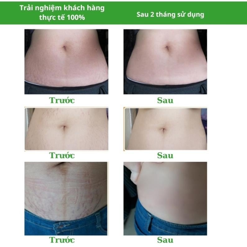 Kem rạn da SNMLPM hỗ trợ giảm sẹo sau sinh Kem dạn da sau sinh làm trắng và săn chắc mịn màng TP07