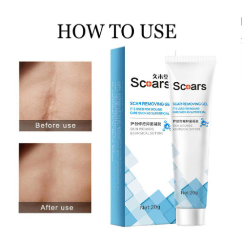 Gel Mờ Sẹo Thâm Scal Remiving Gel hỗ trợ các vết sẹo lâu ngày, các vết rạn da lâu năm