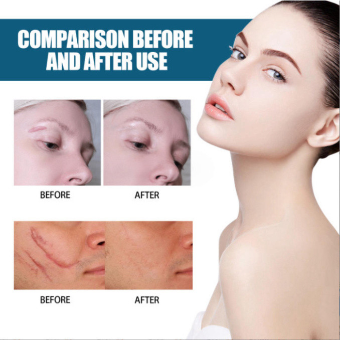 Gel Mờ Sẹo Thâm Scal Remiving Gel hỗ trợ các vết sẹo lâu ngày, các vết rạn da lâu năm