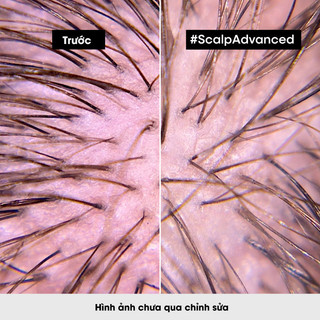 [GIFT ] Dầu gội dưỡng tóc dịu nhẹ giúp cân bằng da đầu chuyên nghiệp L'Oréal Professionnel Scalp Advanced 10ml