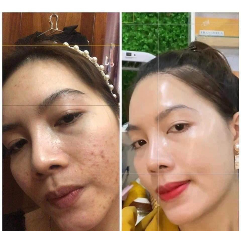 Serum mụn Antiacne 10+, 10x2 ADA Hỗ Trợ Mụn Viêm,Mụn Ẩn,Mụn đầu đen Thanh Lọc da,Thu Nhỏ Lỗ Chân Lông