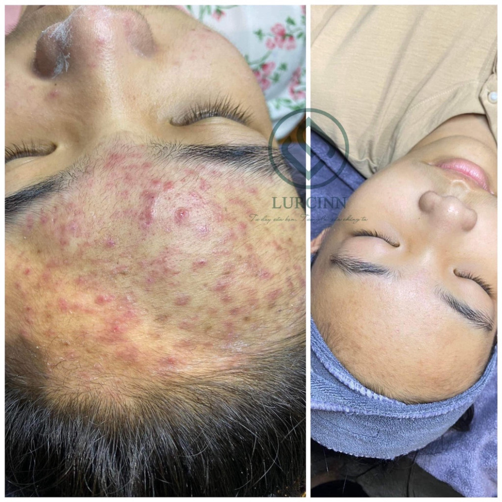Serum Mụn LURCINN Prevent Acne Detox Chăm Sóc Da Mụn Mờ Thâm 10ml