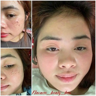 Navo Peel 2 (Mẫu mới - 3 lọ x 30ml)