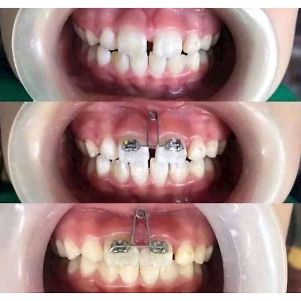 Loop đóng khoảng răng cửa dây Titanium ( combo 3 sợi )