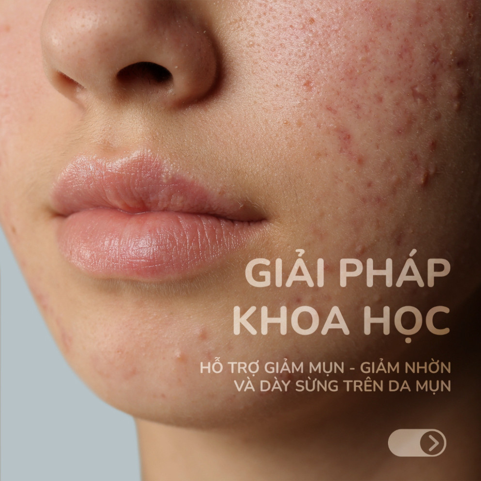 F Gel Giảm Mụn NEOTHERA Acnes Gel, Mờ Thâm Sẹo Mụn & Cải Thiện Da Dầu, Mụn 15ml (Tuýp) F