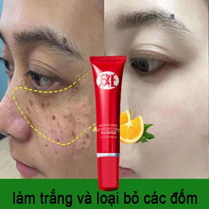 Kem diệt tàn nhang (Loại bỏ tàn nhang nhanh chóng) kem làm trắng da hiệu quả kem ngừa nám Chuyên sâu Loại bỏ các đốm đen