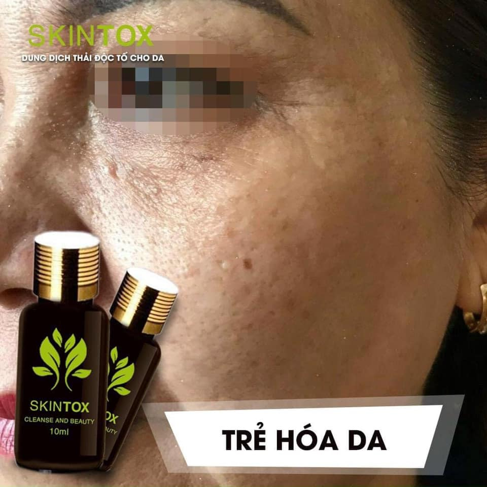SERUM ĐÀO THẢI MỤN NÁM SKINTOX