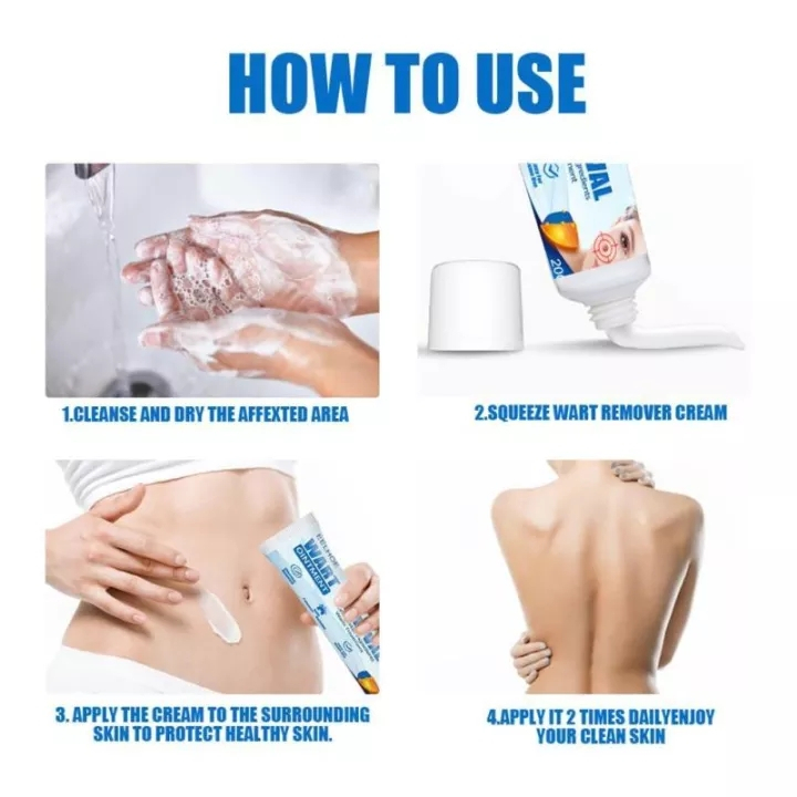 Trị mụn cóc kem loại bỏ mụn cóc 20g xóa nốt ruồi mụn cóc mụn thịt sạch mụn thịt thừa mụn thịt, tàn nhang