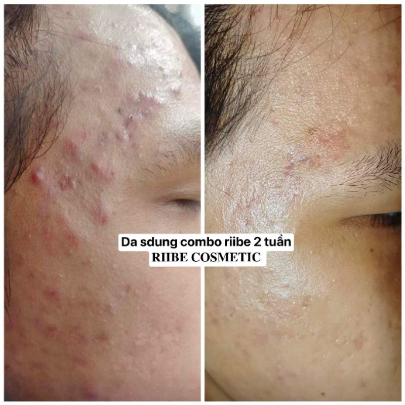 SERUM RIIBE  tặng 30ml sữa rửa mặt riibe +quà