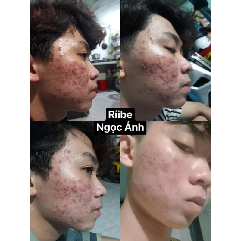 COMBO RIIBE  tặng kèm quà