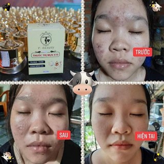 Kem mụn X10