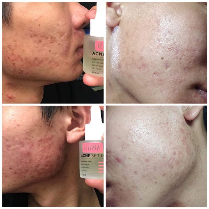 COMBO RIIBE  tặng kèm quà