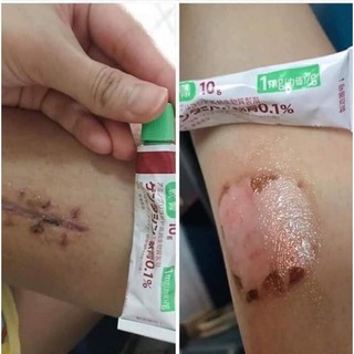 Kem giảm thâm mờ sẹo Gentaci