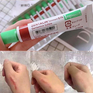 Gel mờ sẹo mụn Nhật ngăn ngừa mụn mủ, mụn đầu đen, mờ thâm, liền sẹo kèm theo sưng tấy, đau nhức