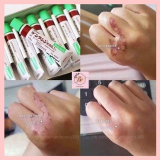 Kem giảm thâm mờ sẹo Gentaci