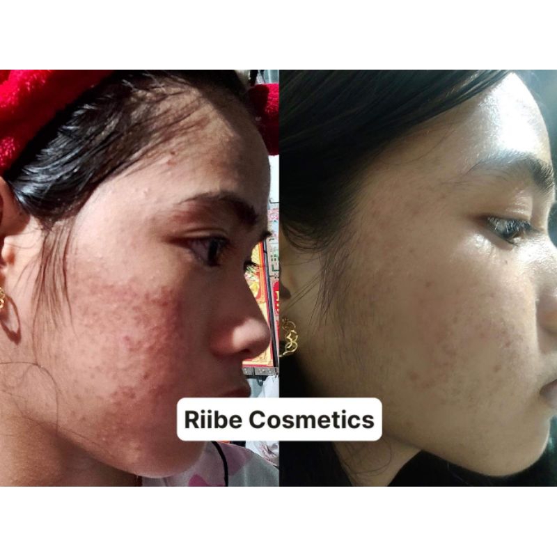 COMBO RIIBE  tặng kèm quà