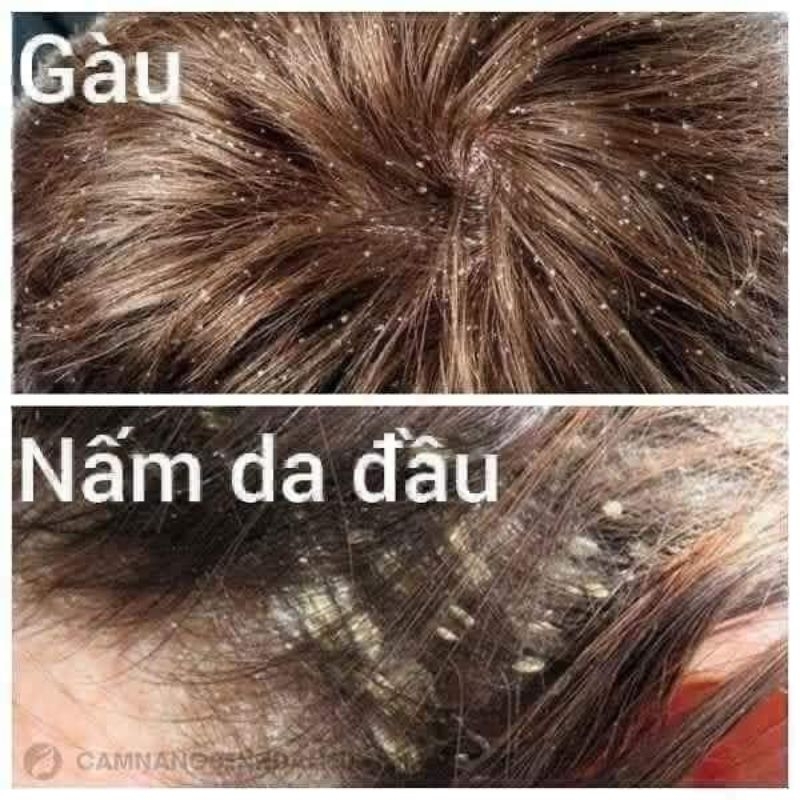 Dầu gội sạch gàu và giảm ngứa da đầu Selsun Anti Dandruff Shampoo