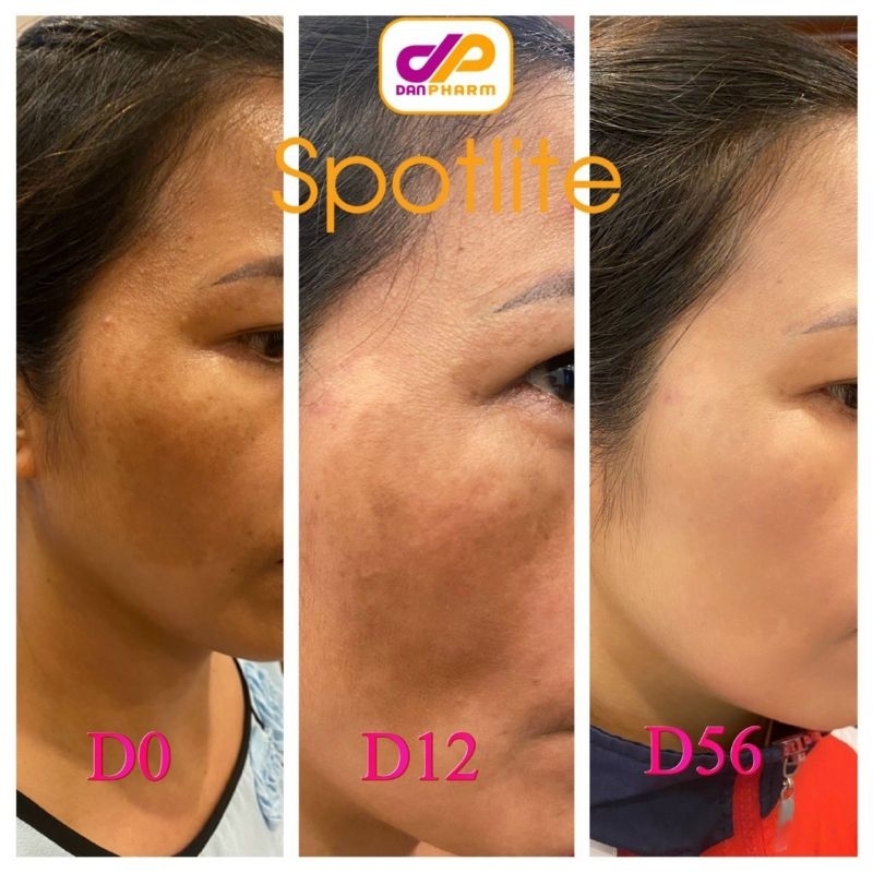 Kem nám Spotlite công nghệ mArn Liposome giảm nám hiệu quả