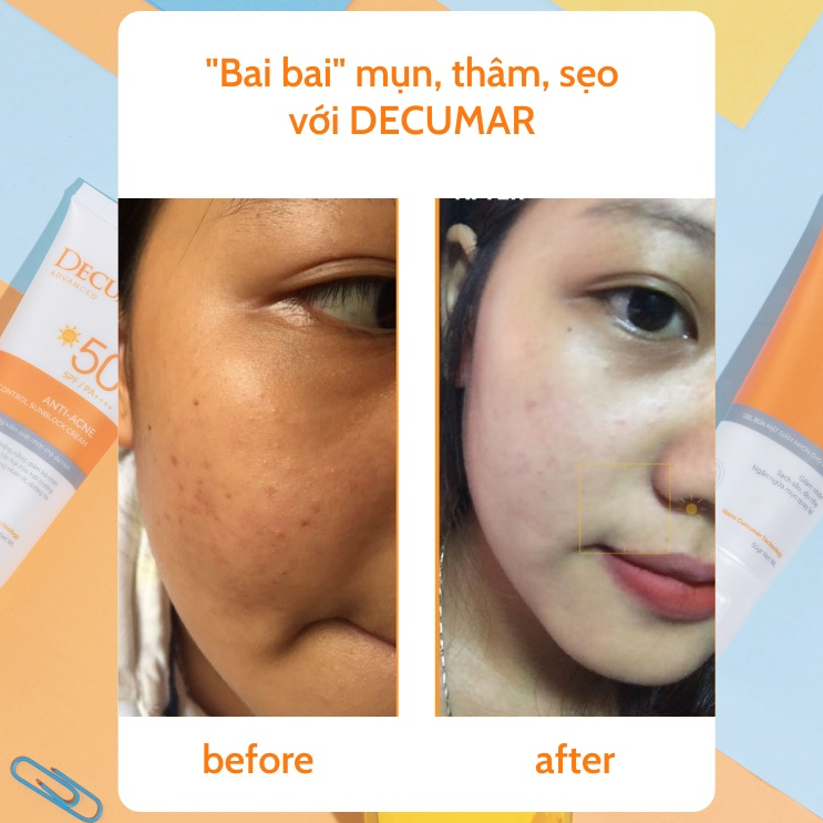 Gel ngừa mụn Nano Decumar Advanced 20g - AJA'S SKINLAB